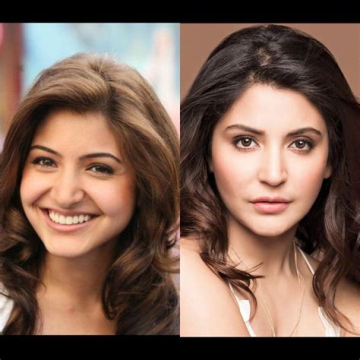 Anushka Sharma Plastic Surgery Before And After