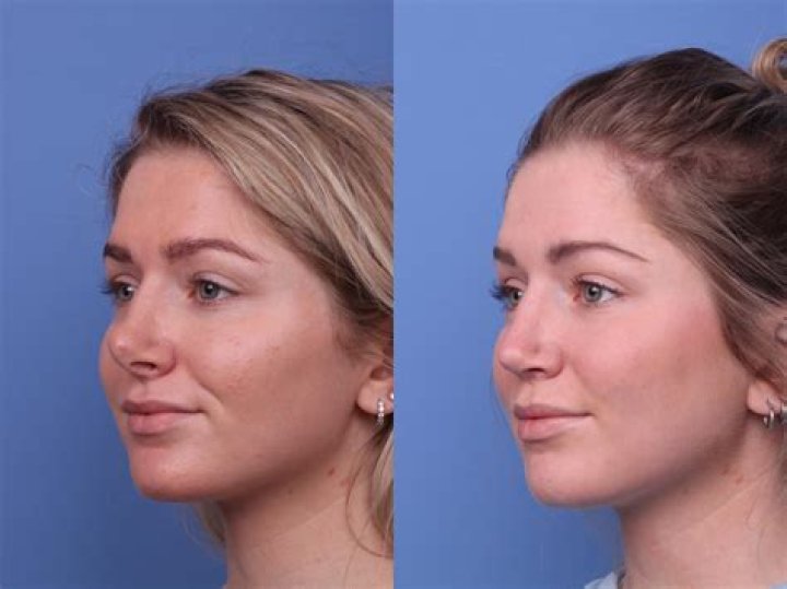 Ethan Slater Nose Job | Before And After Photos