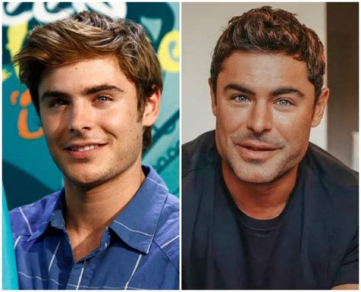 Outer Banks: What Is Wrong With Chase Stokes Eyes And Face? Has He Done A Plastic Surgery?